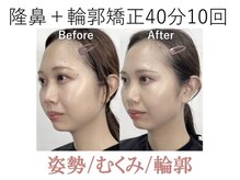 ラプリ 大阪心斎橋店(Raplit)/隆鼻＋輪郭矯正40分10回