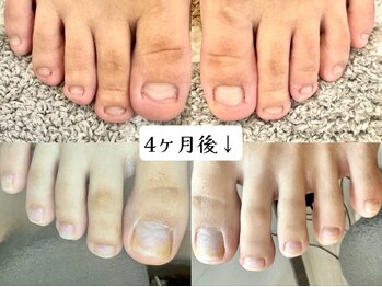 グラシナ なんば店/深爪/自爪育成/フィルイン