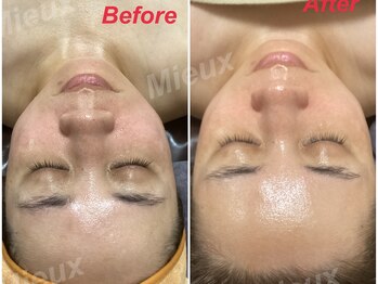 ミュー 新小岩店(Mieux)/セラピール+小顔コルギ一回効果