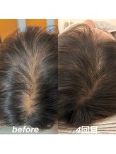 経堂鍼灸整体院/育毛促進鍼＋ヒト幹細胞培養液