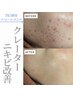 【ニキビ改善】から【色素残り＆凹凸改善まで】悩み別の施術選択で◎最短改善
