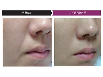 パーフェクトフェイスビューティー 梅田店(PERFECT FACE BEAUTY)/ディレイアコスメ（3種）使用