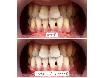 セルフメイド 東大阪店(SELFMADE)/美容ホワイトニング♪ビフォアフ