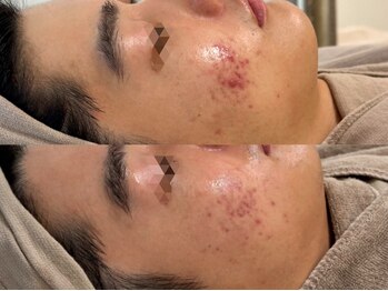 ピブ(PIBU)/男性ニキビ/ハーブピーリング