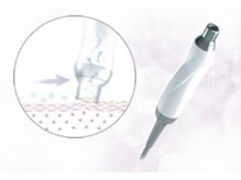 ピティン(Pitin)/ダイヤモンドピーリングとは