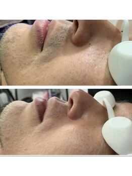 ベラーモ(BELLAMO)/ヒゲ脱毛