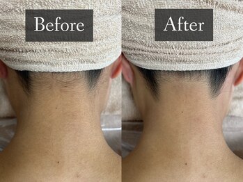 ベルフィーヌ 恵比寿店(BELFINE)/大人気うなじ脱毛