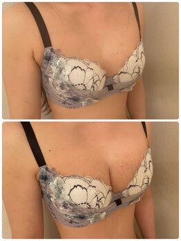 ソラ(sora)/バストアップ・バストケア症例★