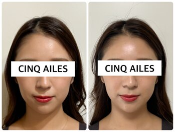 サンクエール 代官山鍼灸院(CINQ AILES)/美容鍼灸　浮腫み改善・小顔