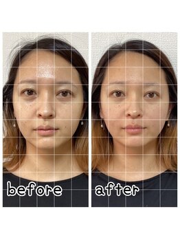 小顔整体 優/お顔のバランスが整う♪