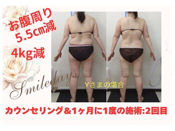 スマイルデイズ(Smiledays)/月に1回の施術、まだ2回目です