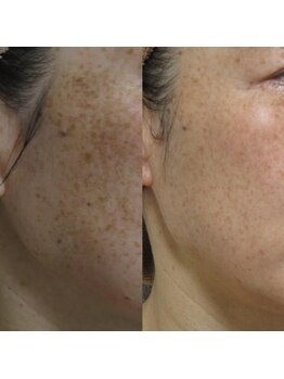 エステルーム アンジュ(Esthe Room Ange)/ADSプログラム/インスタ症例