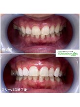 ホワイトニングサロン 名古屋駅店/【ホワイトニング施術例】