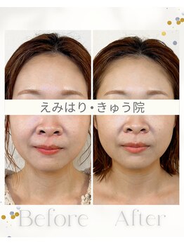 えみはりきゅう院/電気美容鍼とヘッド&首こりの鍼