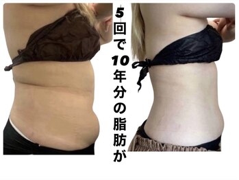 ジール(ZEAL)/痩身/ダイエットプランのお客様