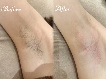 Beauty Salon PIMIL【4/4NEWOPEN(予定)】/ワキ脱毛