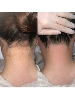 ヴィヴ 熊本(ViV)/うなじWAX＋マシンセット