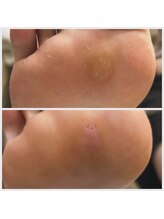 ドクターネイル爪革命 十条店/魚の目たこケア