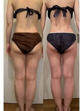 シェリスパ(Cheri Spa)/お尻も大幅にサイズダウン可能!!