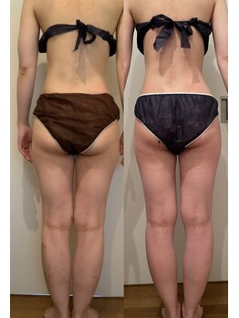 シェリスパ(Cheri Spa)/お尻も大幅にサイズダウン可能!!