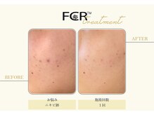 ハーバル 新宿店(HERBAL)/最強★韓国FCRハーブピーリング