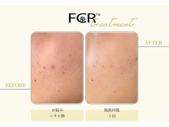 ハーバル 新宿店(HERBAL)/最強★韓国FCRハーブピーリング