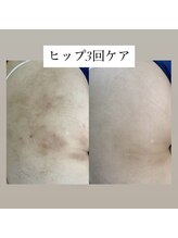 スキンプローズ(skinprose)/ヒップハーブピーリング・ハード