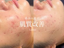 ラティエ(Latier)/ニキビ改善ハーブピーリング