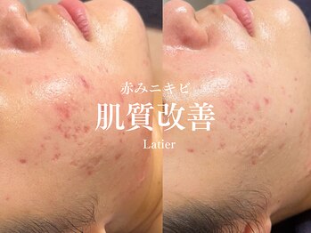 ラティエ(Latier)/ニキビ改善ハーブピーリング