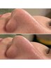 鼻の黒いブツブツ毛穴！白く詰まった皮脂、Tゾーン、アゴ等気になる毛穴に！