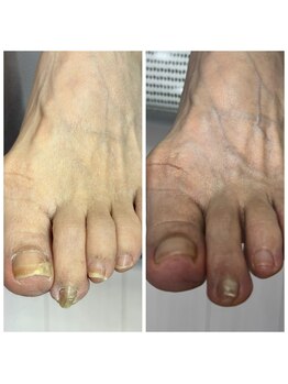 肥厚爪ケア