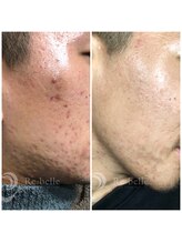 マリーローランメンズグレース(Marryrolan MensGrace)/リベルハーブピーリング症例