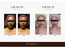 ハンズ鍼灸接骨院小牧院 美容整体ハンズ(美容整体hands)/フェイシャル before after