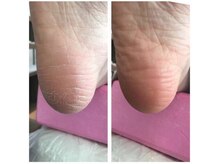 厚木 海老名 巻き爪矯正センター/事例【ドイツ式フットケア】