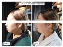 ディアビム(DiAViM)/◆最新エステダーマ導入◆