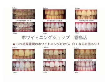 ホワイトニングショップ 霧島店/【症例】