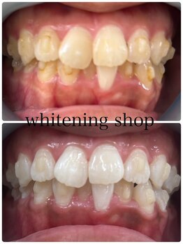 ホワイトニングショップ 北千住店/タバコのヤニも綺麗に