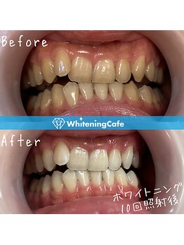 ホワイトニングカフェ 相模大野店(WhiteningCafe)/【ビフォーアフター】10回