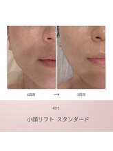 リアン(Lien)/40代 ビフォーアフター