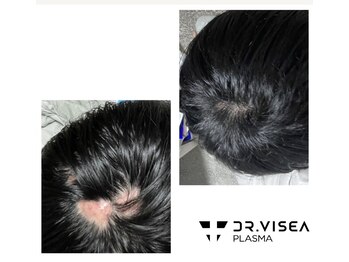 サリエ エン(S'allier en)/プラズマ頭皮ケア