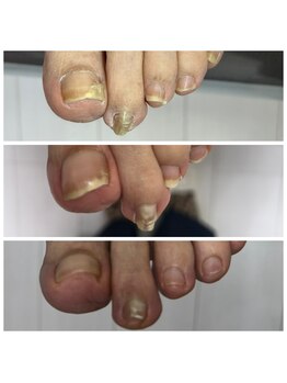 肥厚爪ケア