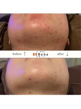 ベベ 大阪中央店(Be’be’)/お肌のくすみが変化する