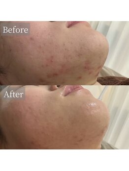 ホワイトアクア 鳳店(WHITE AQUA)/ハーブピーリングフェイスライン