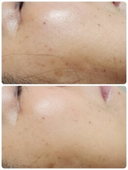 ホワイトビューティーラボ(White Beauty Lab)/RIVIVEハーブピーリング