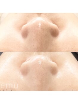 エミュ(emu)/waxで黒ずみケア！