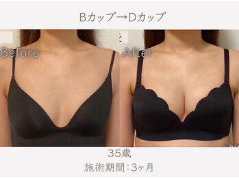 ハリスタ 京橋院(HARISTA)/BEFORE AFTER【バストアップ】
