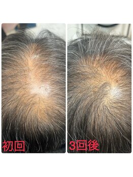 ニューユー(NewYou)/ノアグロウスカルプ