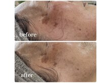 エステサロンブランシュ(Esthe salon Blanche)/ハーブピーリングでエイジング