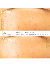 エスプリ 銀座店/ハーブピーリング銀座