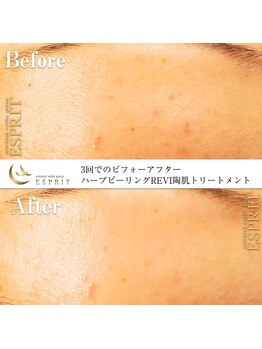 エスプリ 銀座店/ハーブピーリング銀座